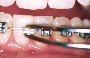 loose-brackets