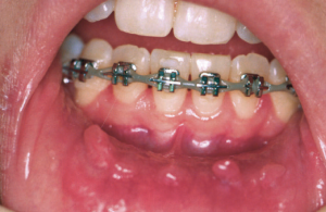 mouth-sores