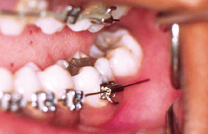 protruding-wires